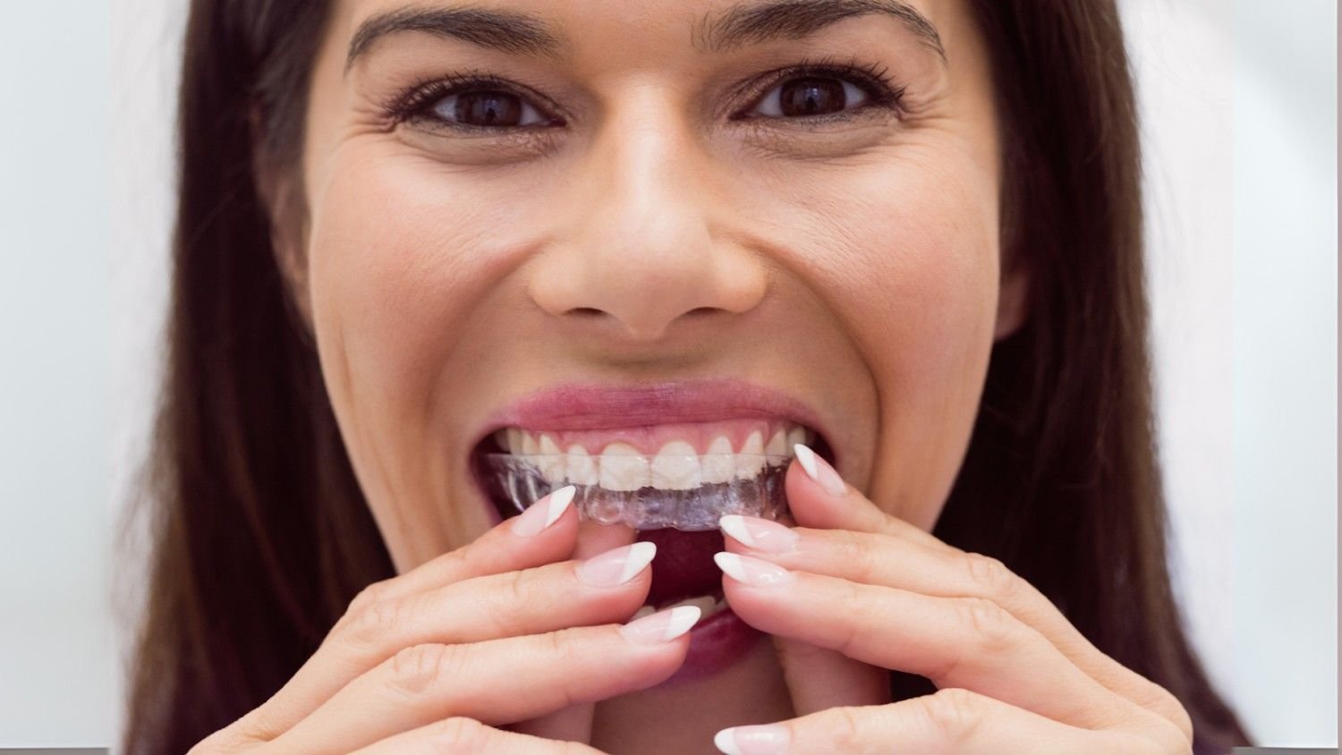 Can Braces Fix an Overbite Permanently? Answers You’ve Been Looking For
