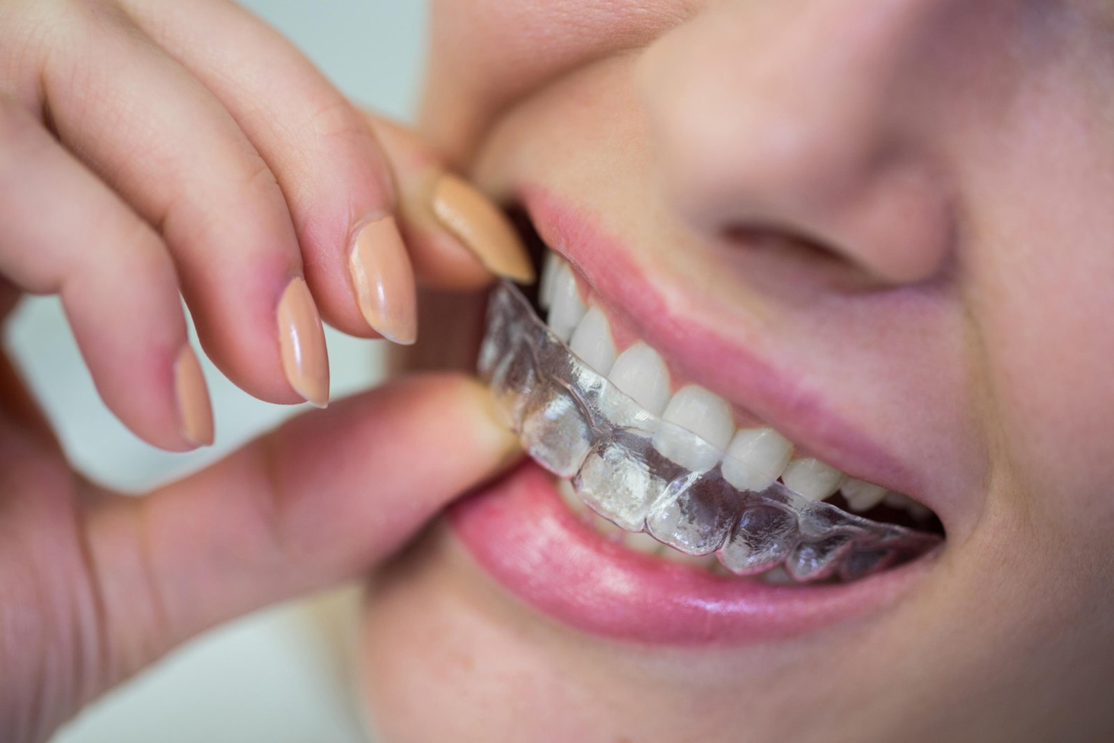 Can Invisalign Fix an Underbite? What Orthodontists Want You to Know