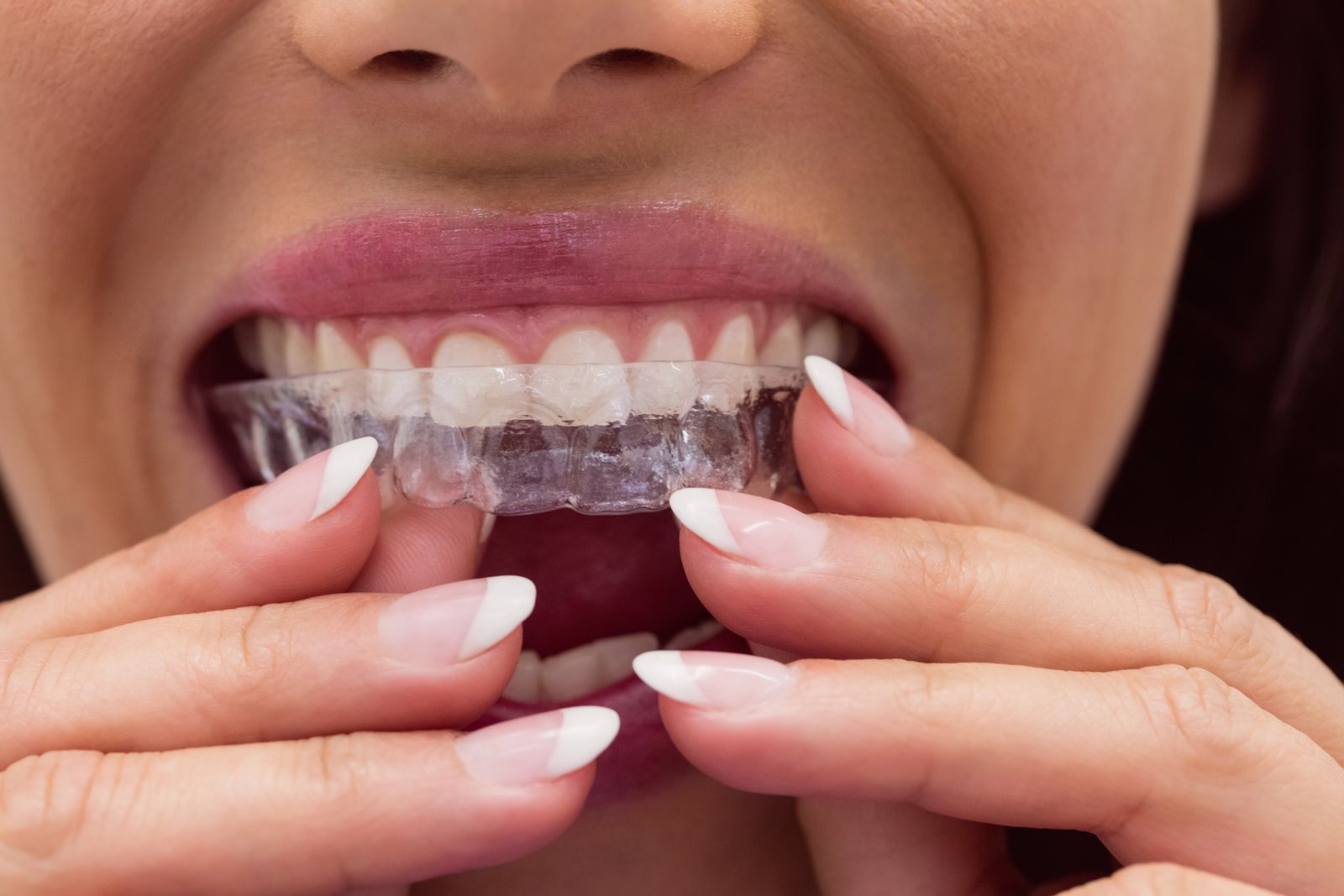Does Invisalign Hurt? Truth About Pain, Pressure & Comfort