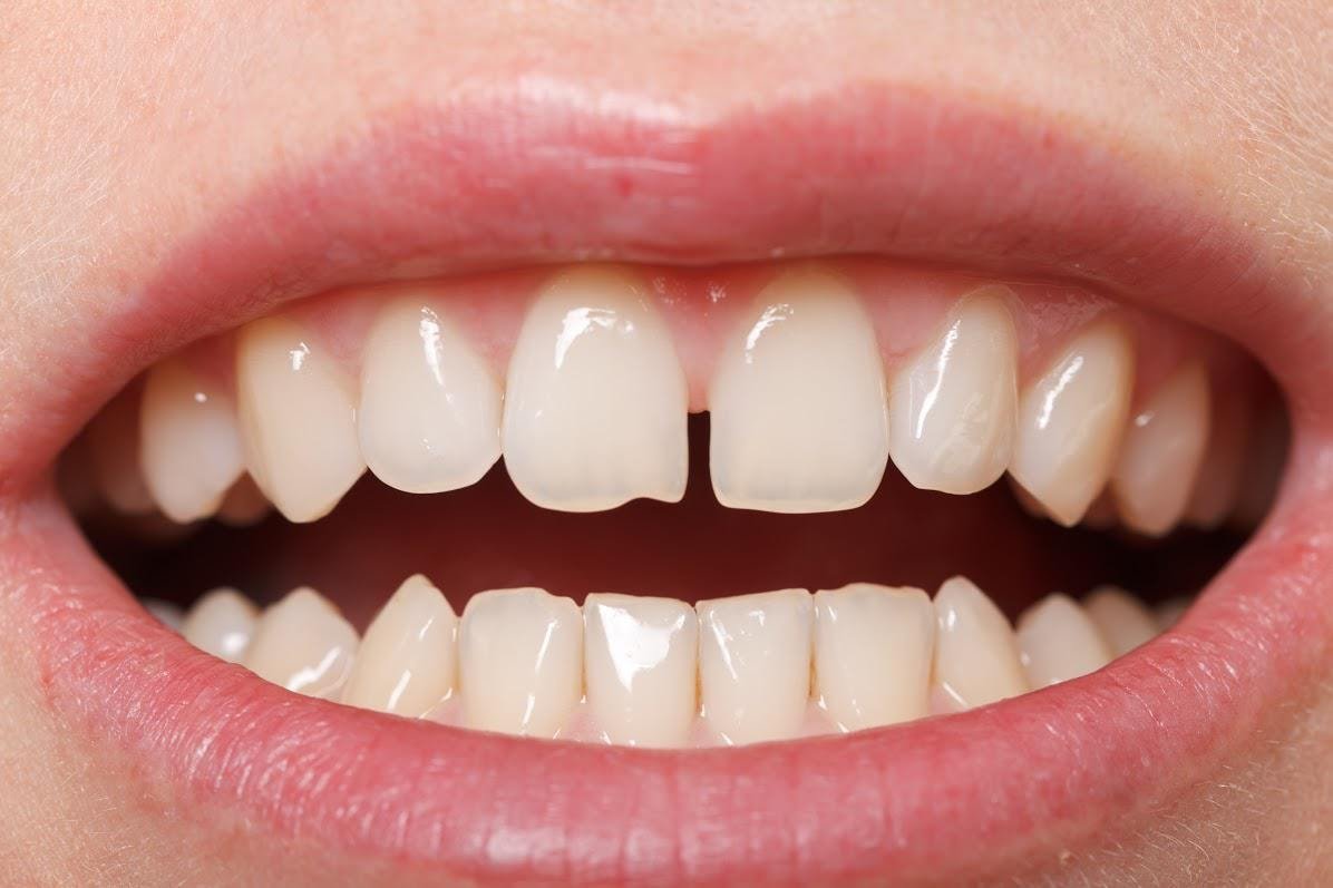 How to Fix a Gap Between Teeth? Treatment Options Compared