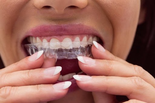 Orthodontic impression technique