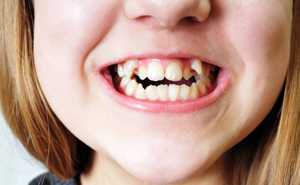 What Causes Crowded Teeth and How Dentists Fix Them?