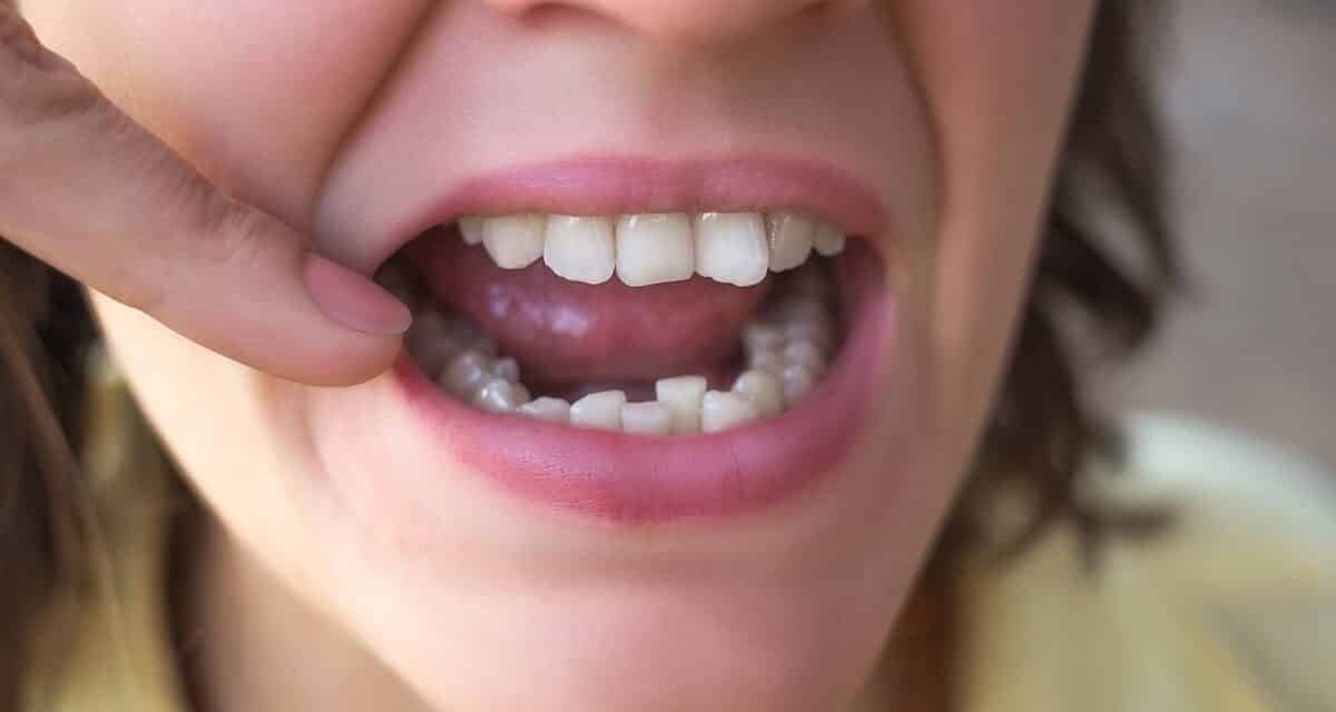 Crowded Teeth