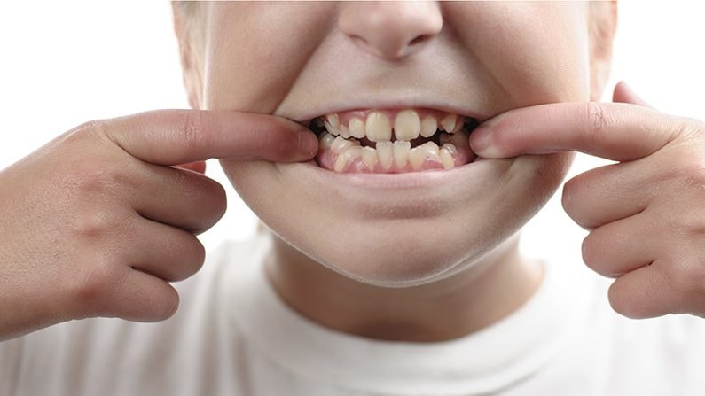 What is Malocclusion of Teeth? Symptoms, Diagnosis, and Care