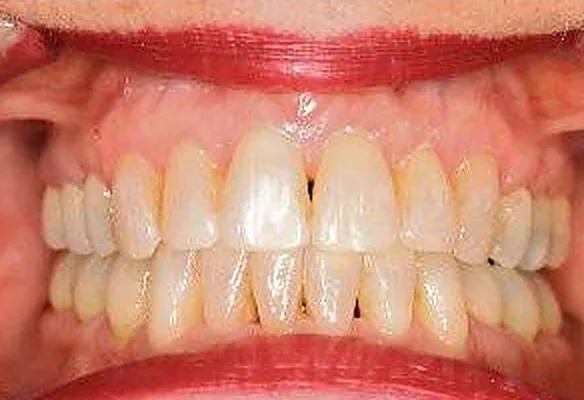Patient 1’s teeth after orthodontic treatment at Dante Gonzales Orthodontics