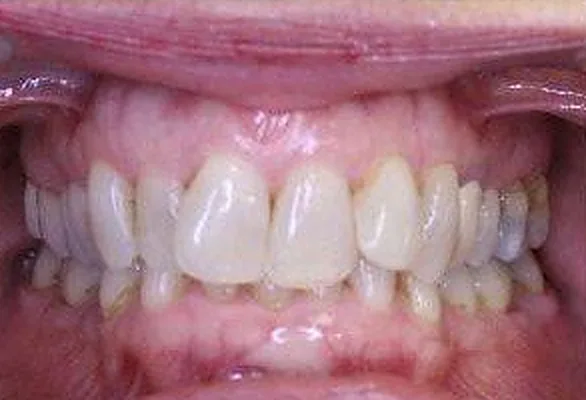 Patient 1’s teeth before orthodontic treatment at Dante Gonzales Orthodontics