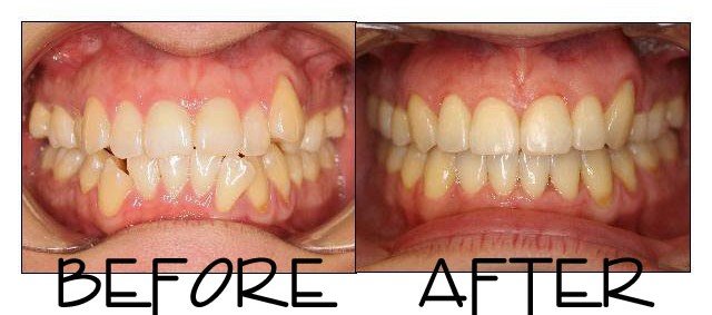 Patient 4 before and after orthodontic treatment at Dante Gonzales Orthodontics