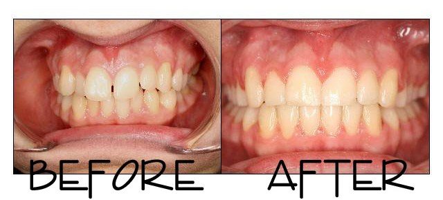 Patient 3 before and after orthodontic treatment at Dante Gonzales Orthodontics