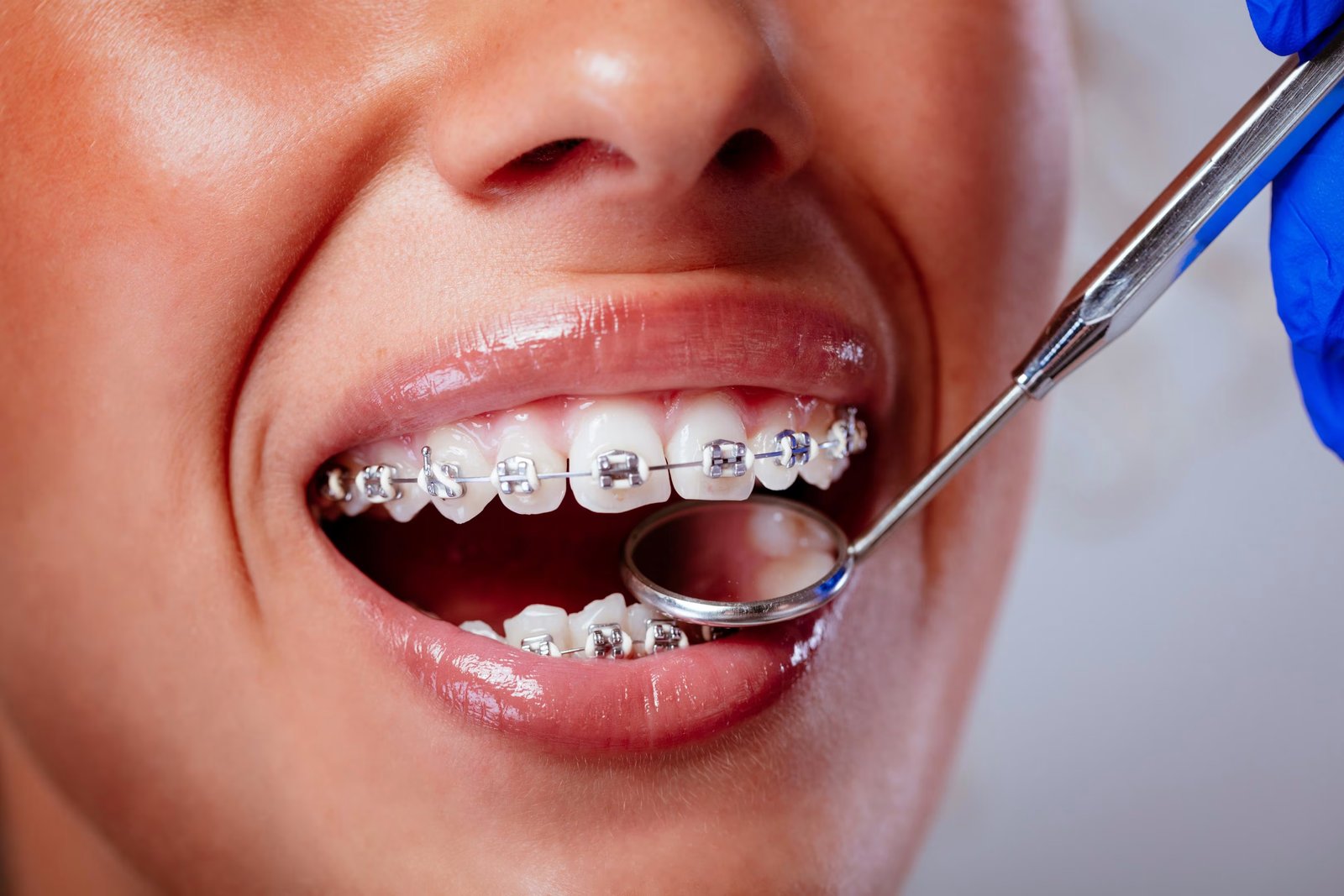 How Much Do Braces Cost in 2026? Full Price Breakdown and Payment Options