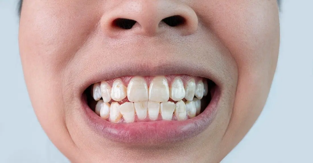 White marks on teeth after braces