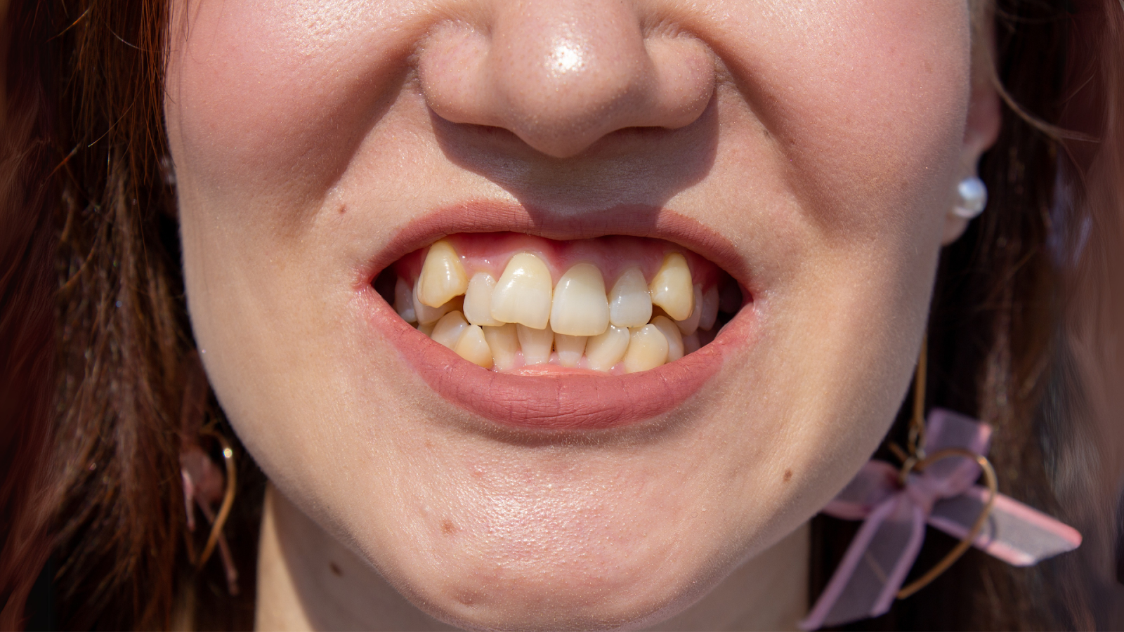 Are braces faster than Invisalign