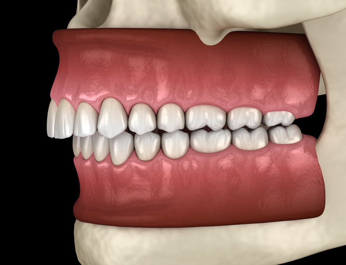 Malocclusion of Teeth