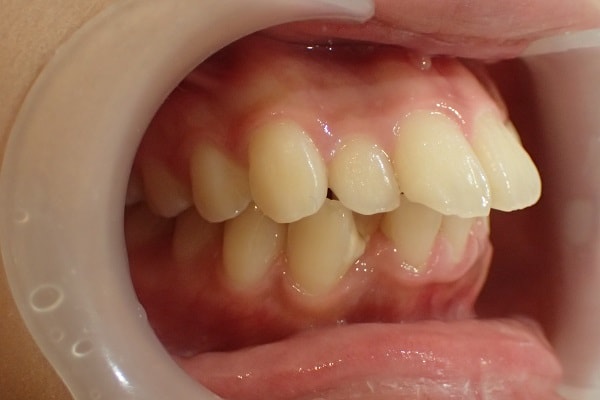 Teeth Protrusion