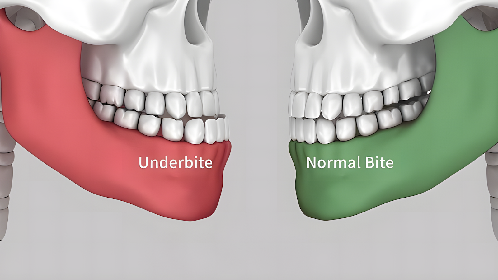 Are braces faster than Invisalign