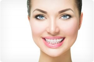 Ceramic braces blending with natural tooth colour
